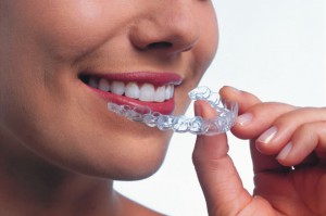 Studio dentistico per invisalign a Pozzuoli