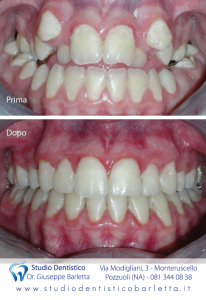 Studio dentistico per invisalign a Pozzuoli